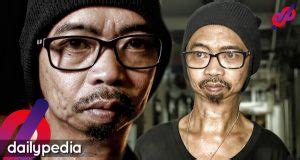 ed caluag disease